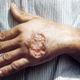 Image: CDC/ Dr. D.S. Martin